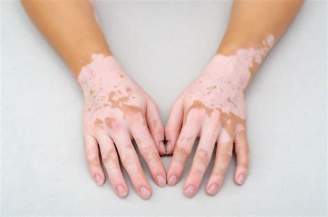 vitiligo fotos|Vitiligo : causes, symptômes, traitements des taches。